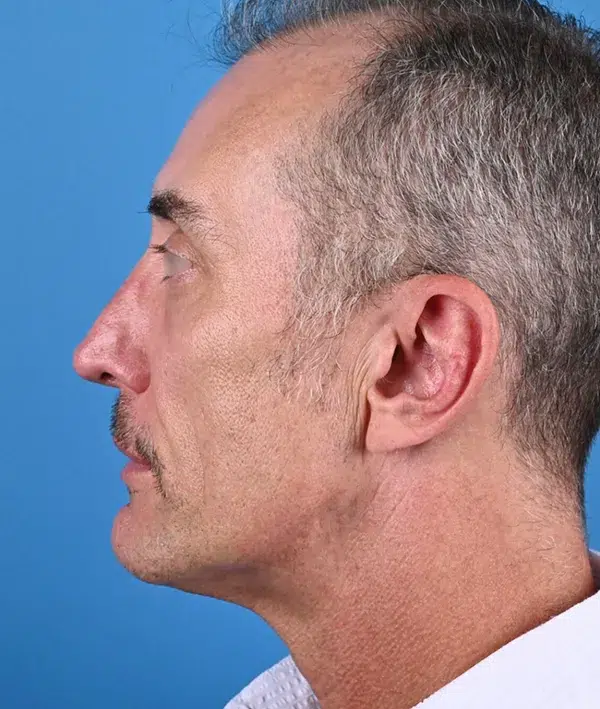 Facial Implants