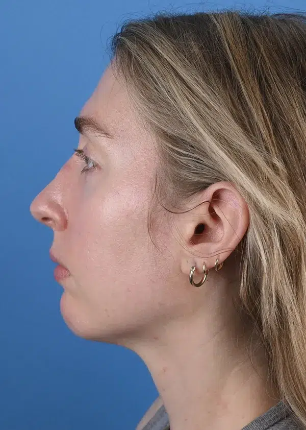 After genioplasty Left Side View