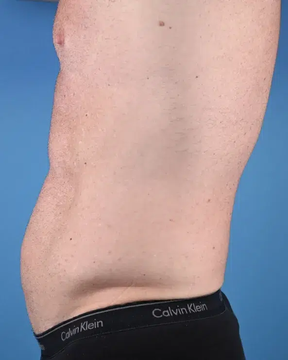 Male Abdominal Etching