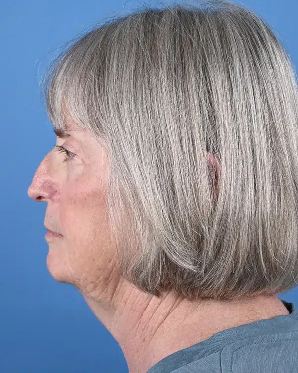 Nasal Reconstruction