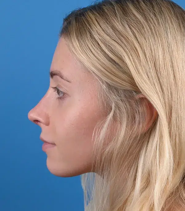 Rhinoplasty