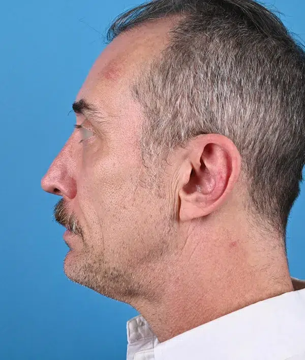 Facial Implants