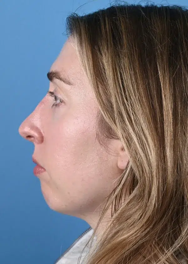 Before genioplasty Left Side View