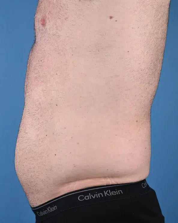 Male Abdominal Etching