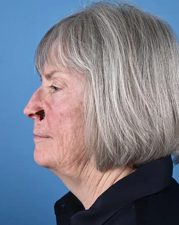 Nasal Reconstruction