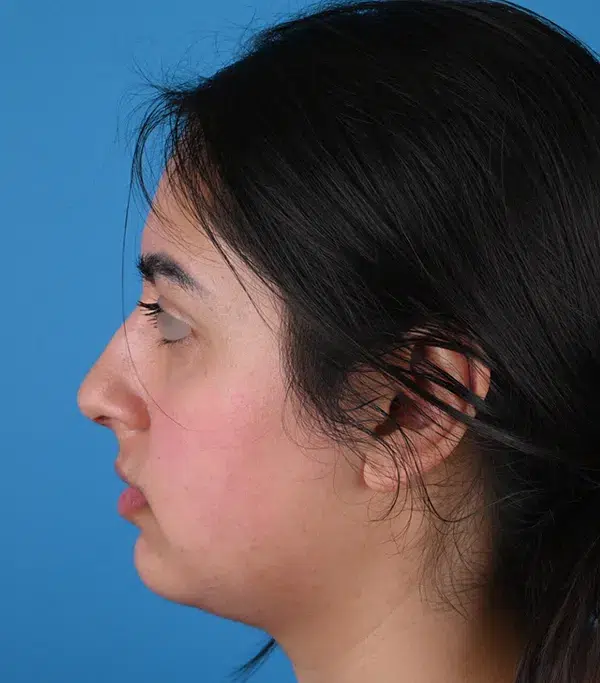 Rhinoplasty