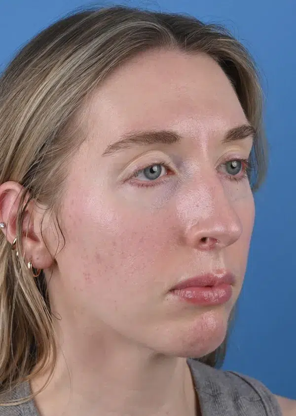 After genioplasty Right Oblique View