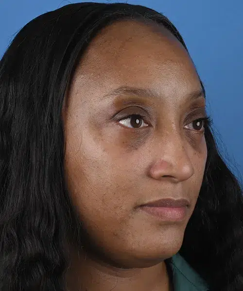 right-oblique-view-after-lower-blepharoplasty-57587