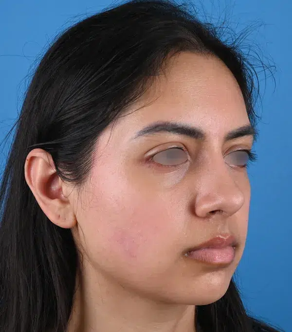 Rhinoplasty
