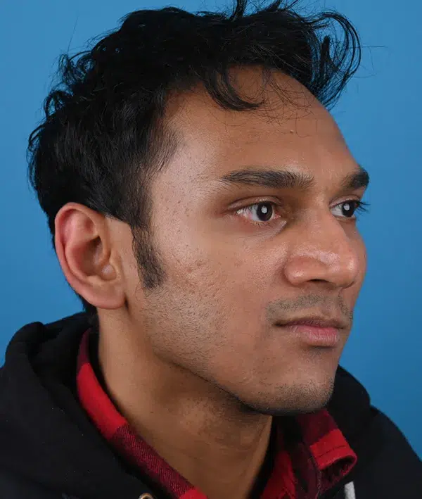 Facial Implants