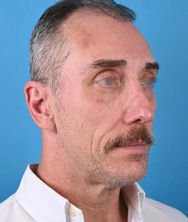 Facial Implants