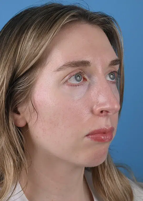 Before genioplasty Right Oblique View