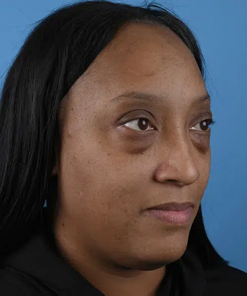 right-oblique-view-before-lower-blepharoplasty-57587