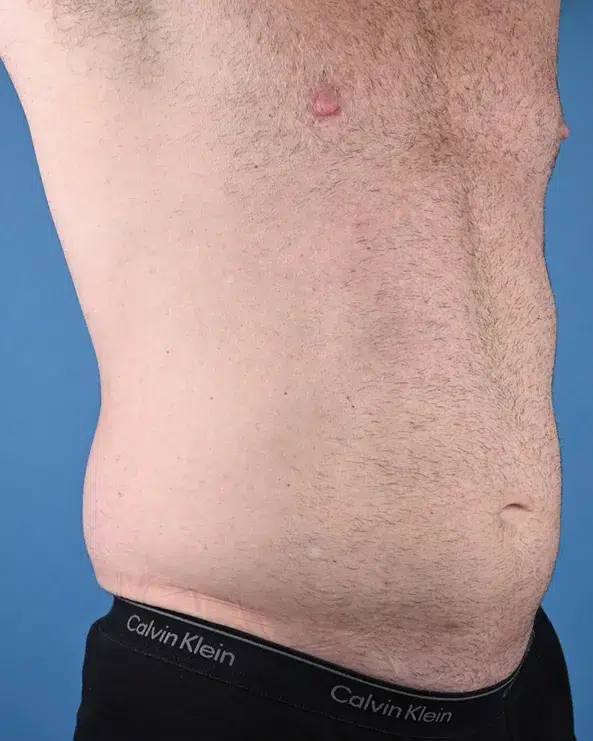 Male Abdominal Etching