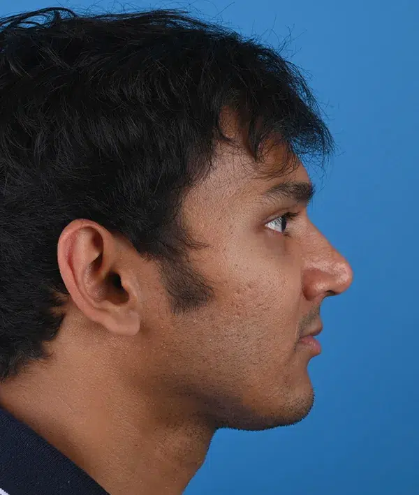 Facial Implants