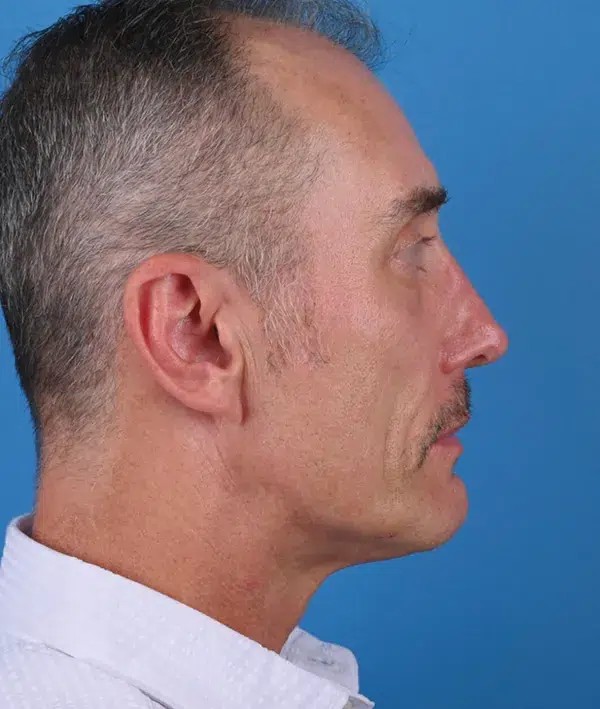 Facial Implants