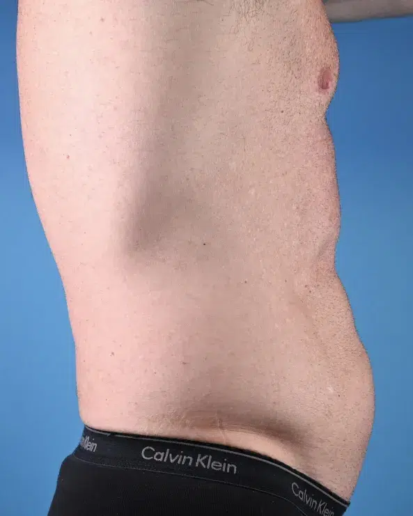 Male Abdominal Etching