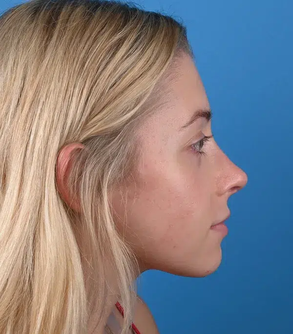 Rhinoplasty