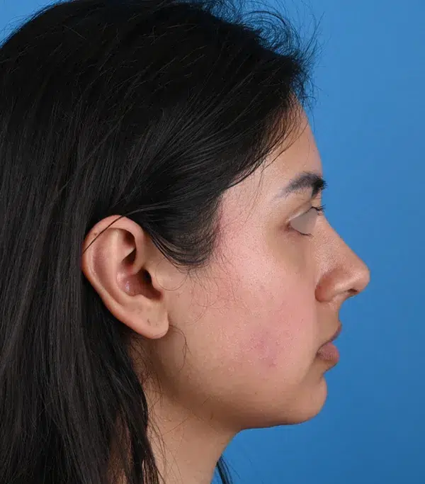 Rhinoplasty