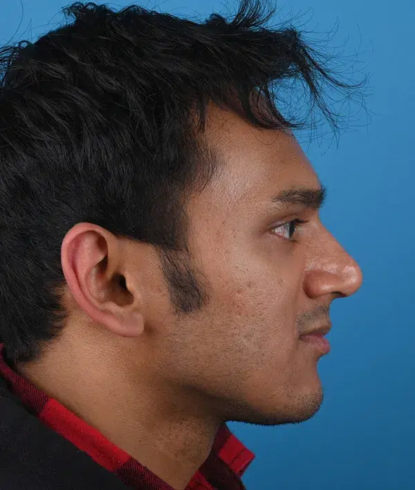 Facial Implants