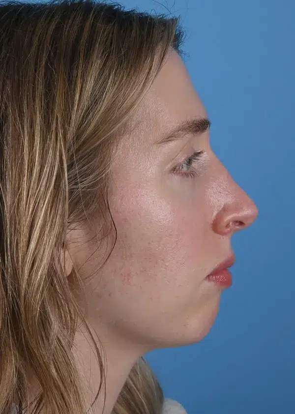 Before genioplasty Right Side View