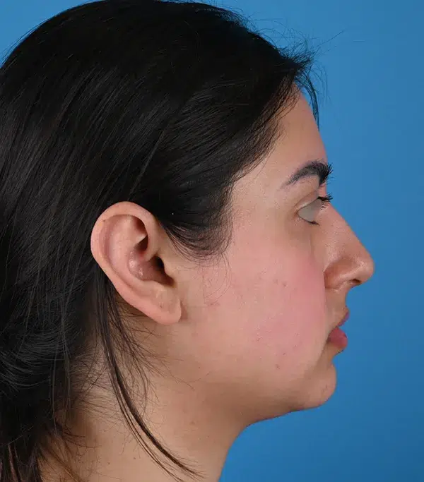 Rhinoplasty