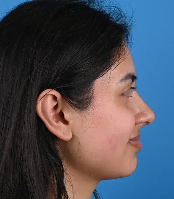 Rhinoplasty