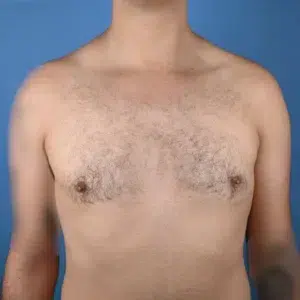 front view after gynecomastia