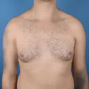 front view before gynecomastia
