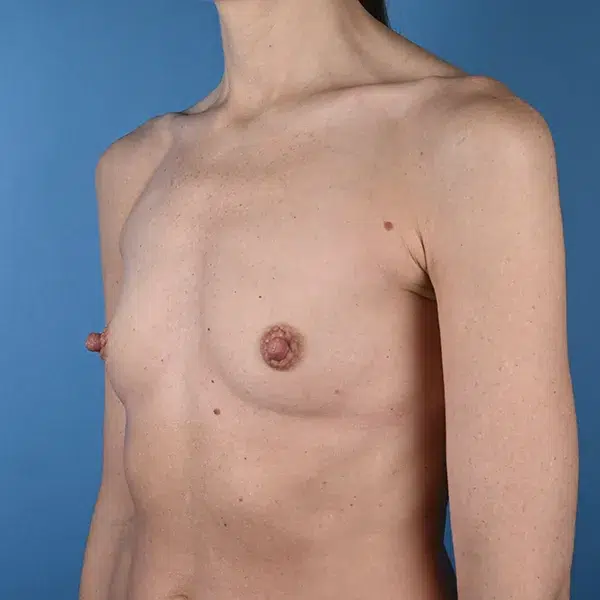 Breast Augmentation