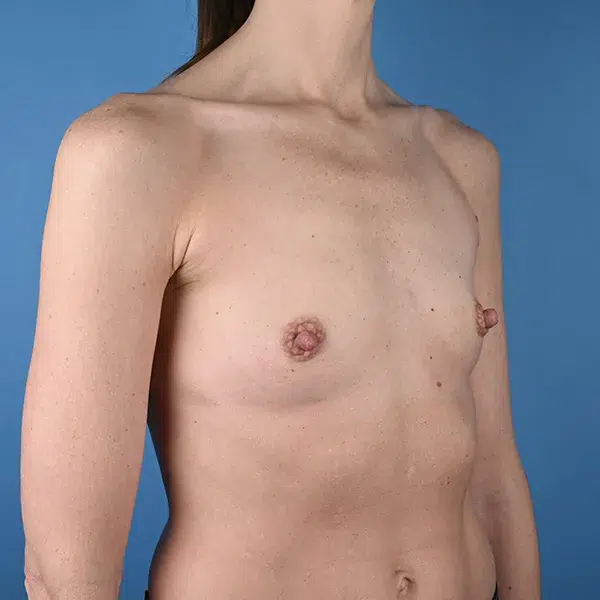 Breast Augmentation