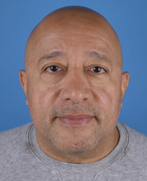 front-view-after-male-genioplasty-60222