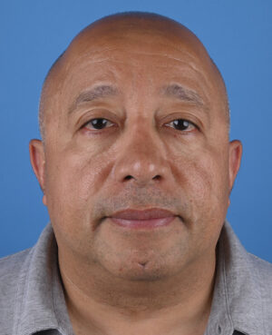 front-view-before-male-genioplasty-60222