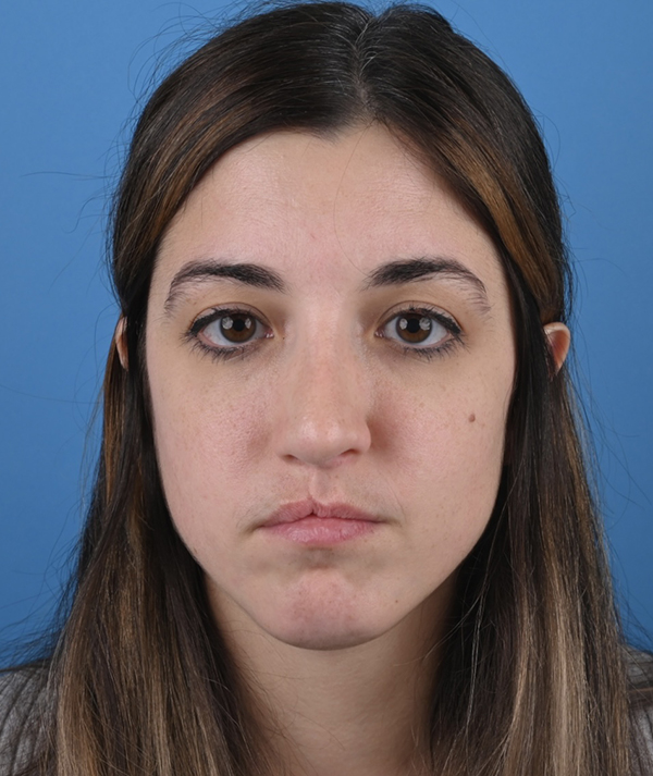 Revision Rhinoplasty