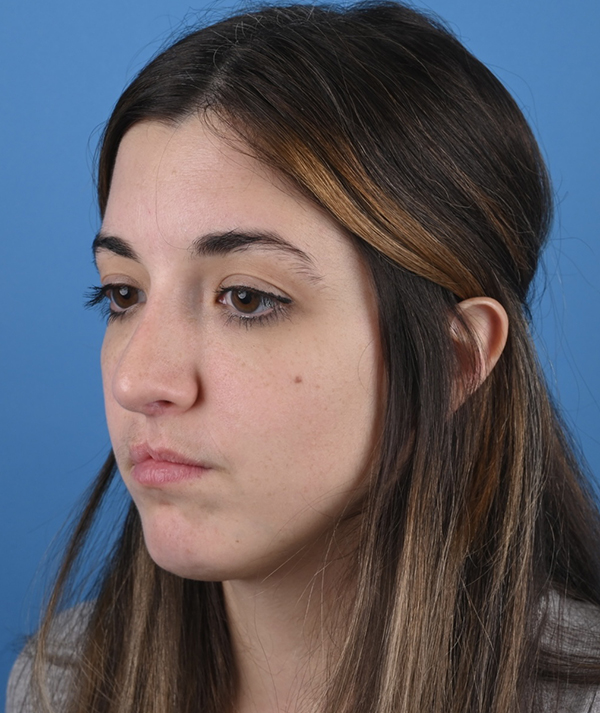 Revision Rhinoplasty