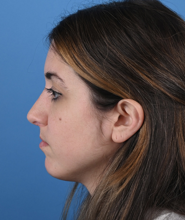 Revision Rhinoplasty