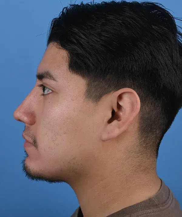 Male Rhinoplasty