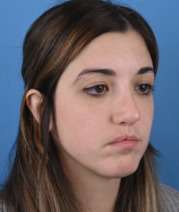 Revision Rhinoplasty