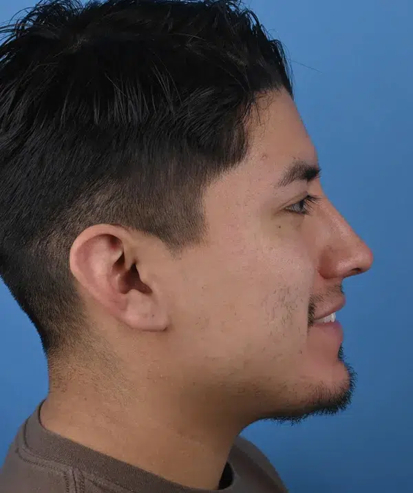 Male Rhinoplasty