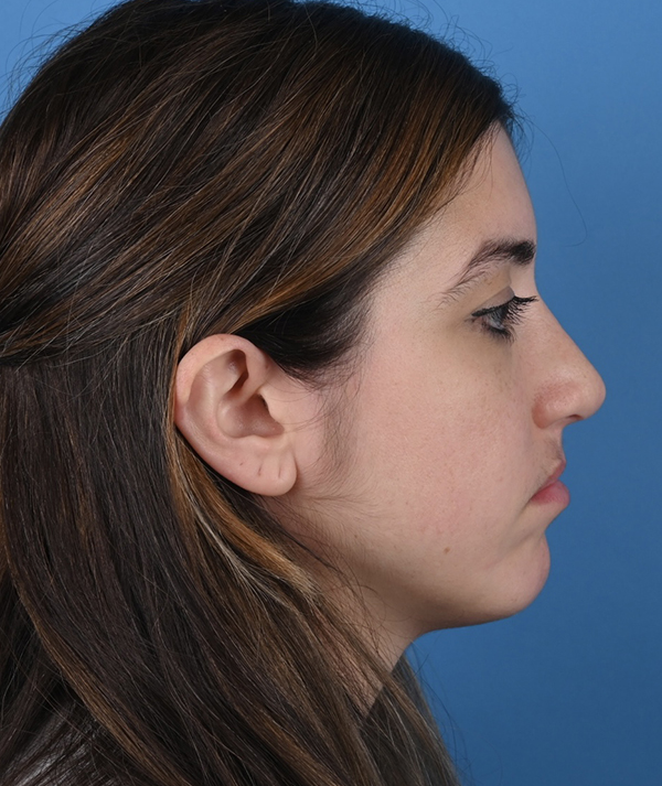 Revision Rhinoplasty