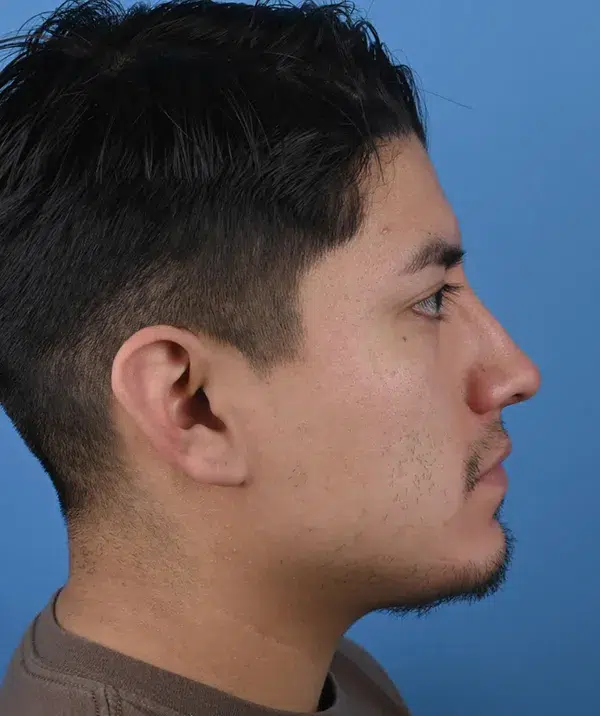 Male Rhinoplasty