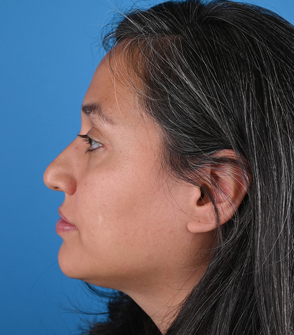 Rhinoplasty