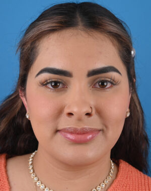 After otoplasty Front View