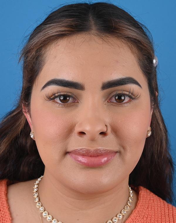 After otoplasty Front View