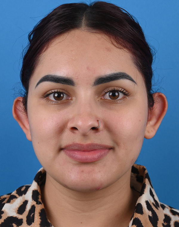 Before otoplasty Front View