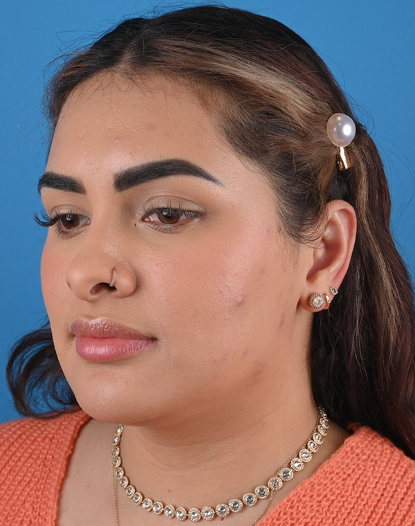 After otoplasty Left Oblique View