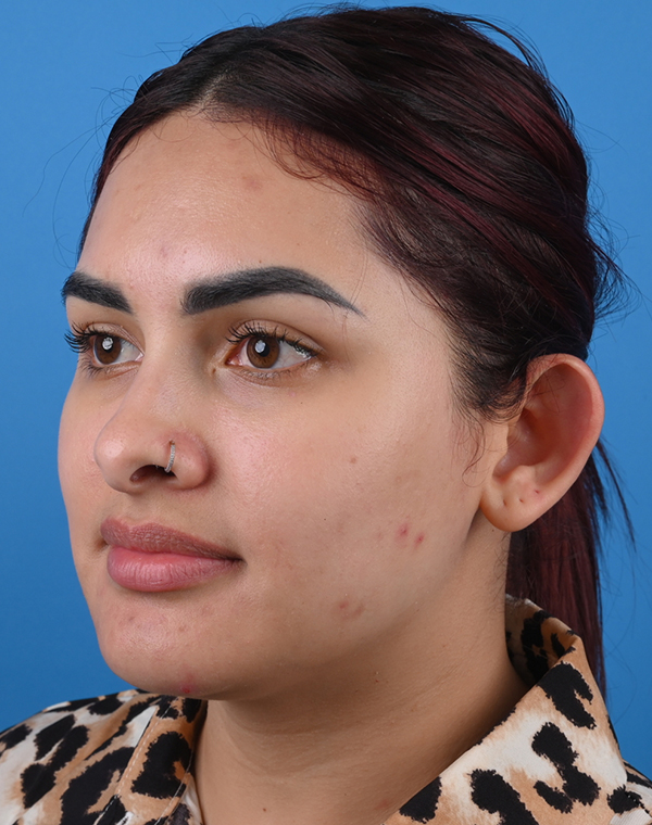 Before otoplasty Left Oblique View