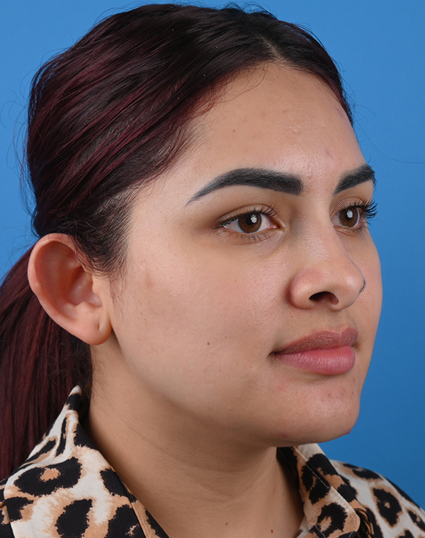 Before otoplasty Right Oblique View