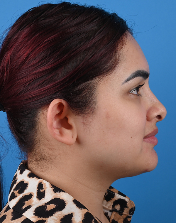 Before otoplasty Right Side View