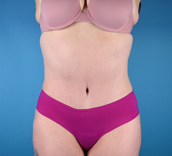 After abdominoplasty Front View
